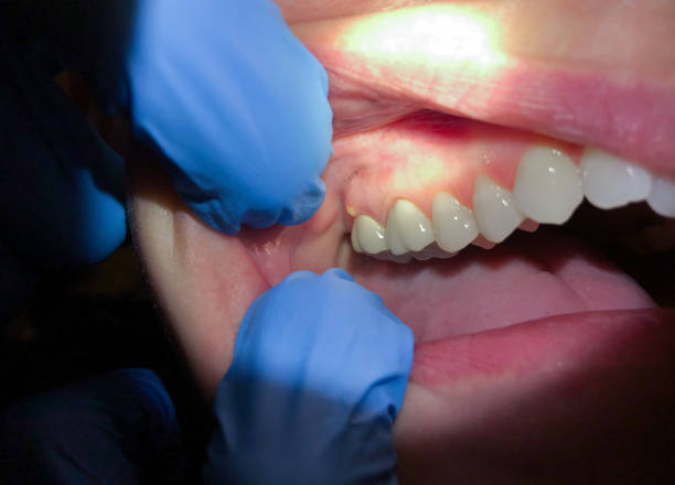 Best Emergency Dental Care for Abscessed Tooth in Crowley, TX